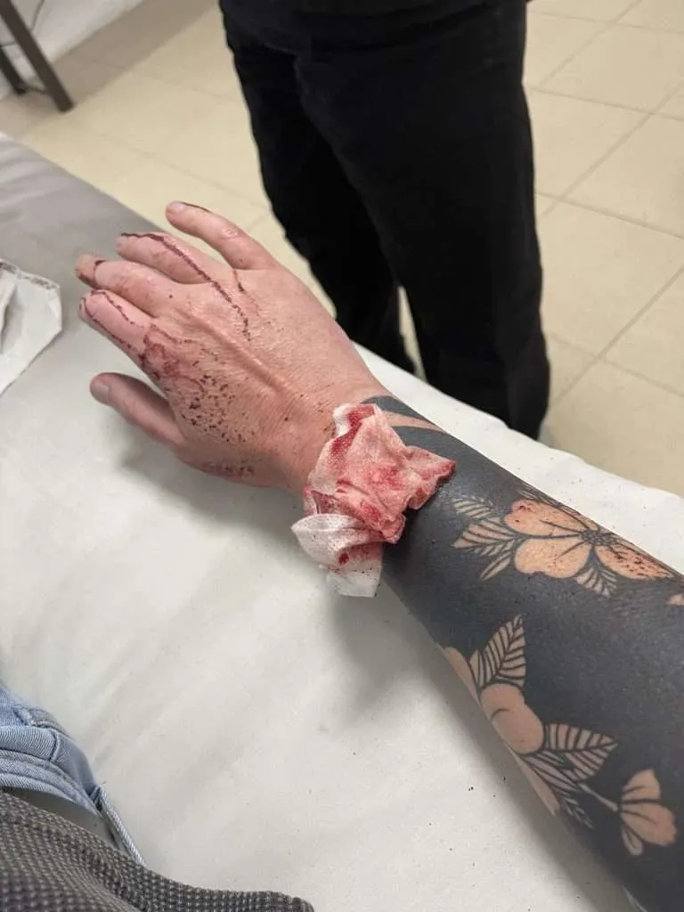 Stabbed through the forearm in Latin America