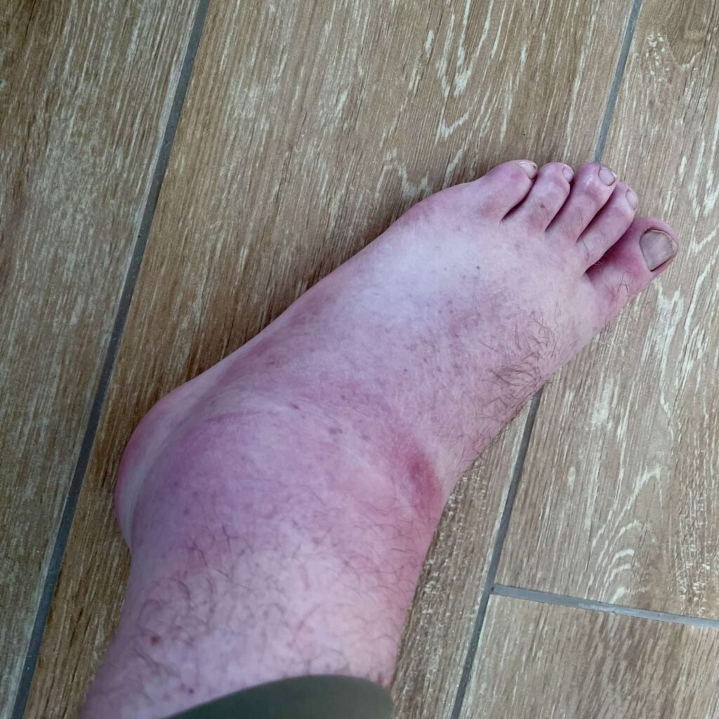 Close-up of severe cellulitis and swelling in a traveler's foot, documenting the biological risks of prolonged exposure in the Madre de Dios basin.